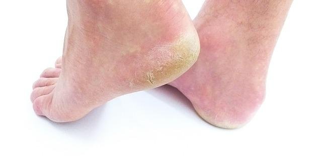 5 Best Foot Cream in India for Cracked Heels